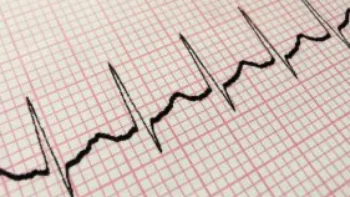 ECG interpretation