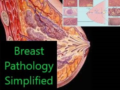شرح كامل ومبسط ل Breast pathology بحالاته المختلفه